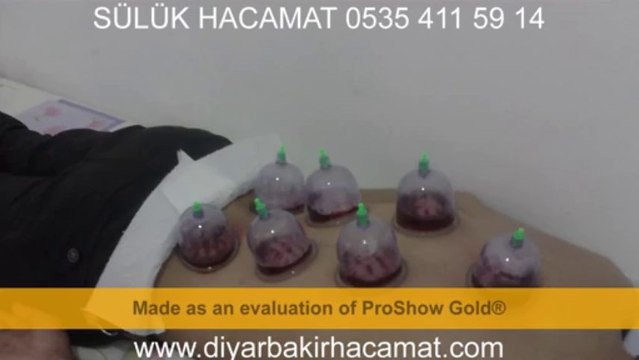 SÜLÜK HACAMAT TEDAVİ DİYARBAKIR 0535 411 59 14