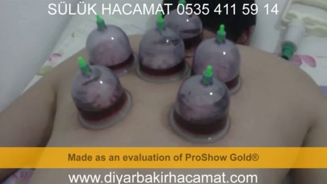 HACAMAT SÜLÜK TEDAVİSİ DİYARBAKIR 0535 411 59 14