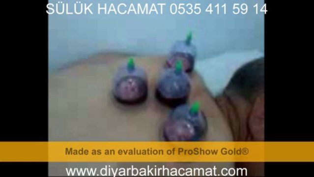 SÜLÜK HACAMAT DİYARBAKIR TEDAVİ MERKEZİ 0535 411 59 14