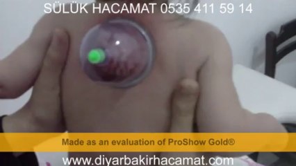 HACAMAT VE SÜLÜK TEDAVİSİ DİYARBAKIR 0535 411 59 14