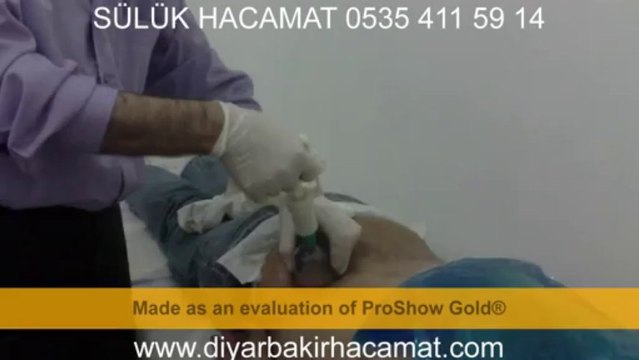 SÜLÜK HACAMAT TEDAVİSİ DİYARBAKIR 0535 411 59 14