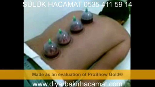 SÜLÜK TEDAVİSİ HACAMAT TEDAVİSİ DİYARBAKIR 0535 411 59 14