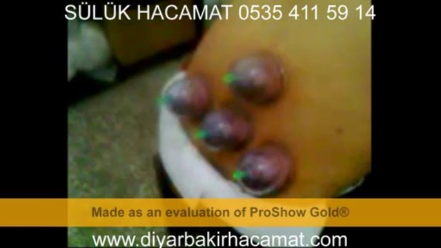 HACAMAT VE SÜLÜK TEDAVİSİ 0535 411 59 14