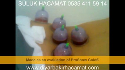 SÜLÜK HACAMAT  TEDAVİSİ DİYARBAKIR 0535 411 59 14