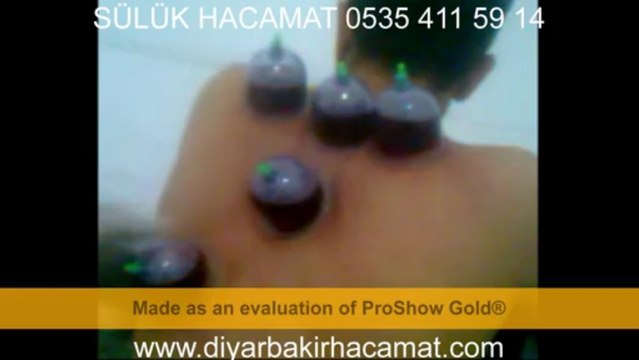 HACAMAT VE SÜLÜK TEDAVİSİ DİYARBAKIR 0535 411 59 14