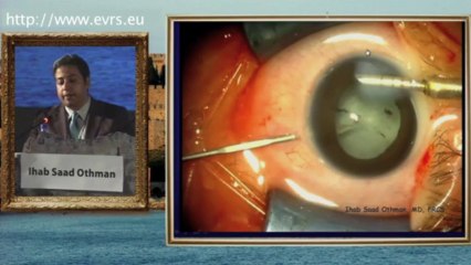 Pars Plana Lensectomy:Vitrectomy in Stages 4 and 5 ROP Ihab Saad Othman