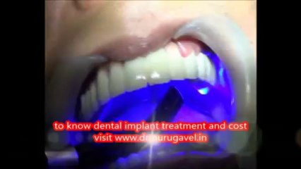 dental implant procedure with zirconium bridge in india