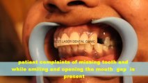 cosmetic dentisry by dental implant procedure in chennai ,india