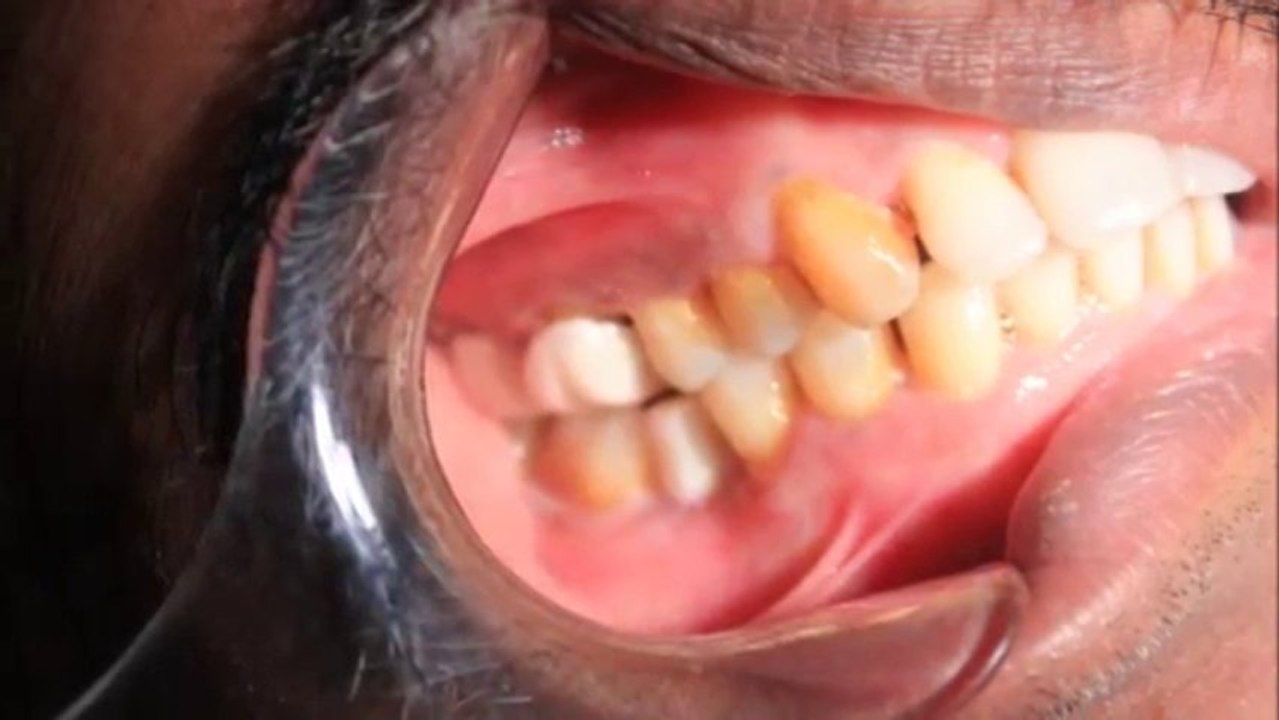 Dental Implants in chennai