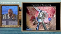 Artificial Iris in the Treatment of Aniridia and Iris Coloboma Cesare Forlini