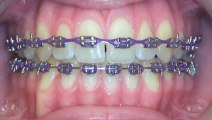 Orthodontic Expander Philadelphia