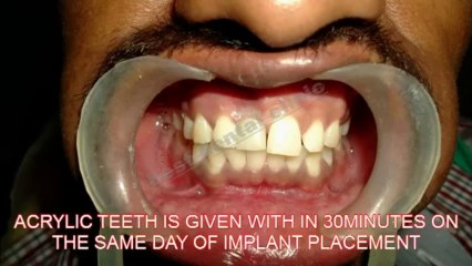 accidental teeth is replaced by an implant with teeth in 1 hour in india