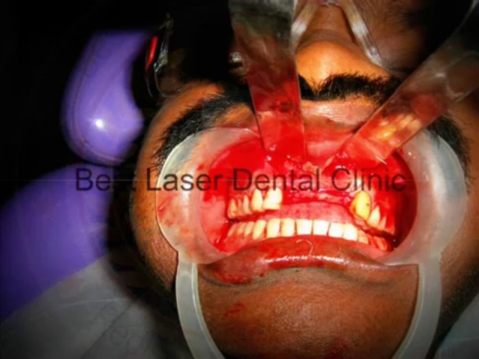 BOI implants (Basal Implants) -An Advanced method of replacing the missing teeth-india