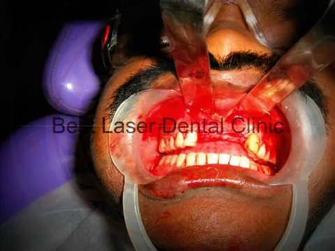 BOI implants (Basal Implants) -An Advanced method of replacing the missing teeth-india