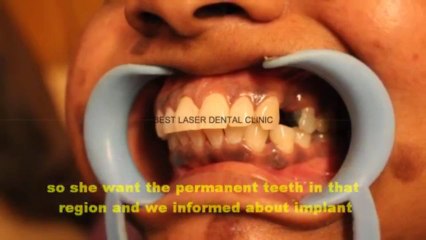 cosmetic dentisry by dental implant procedure in chennai ,india