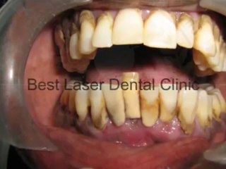 Dental Implant with fixed teeth-india