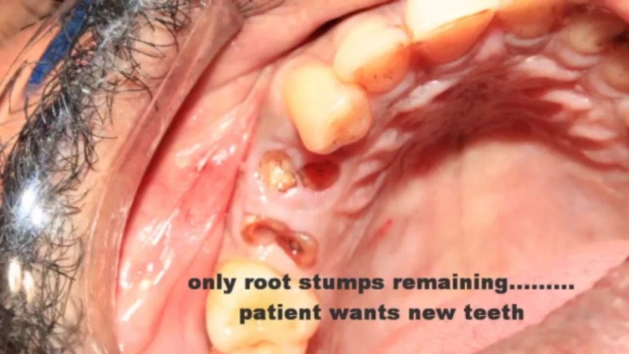 Dental implants in INDIA