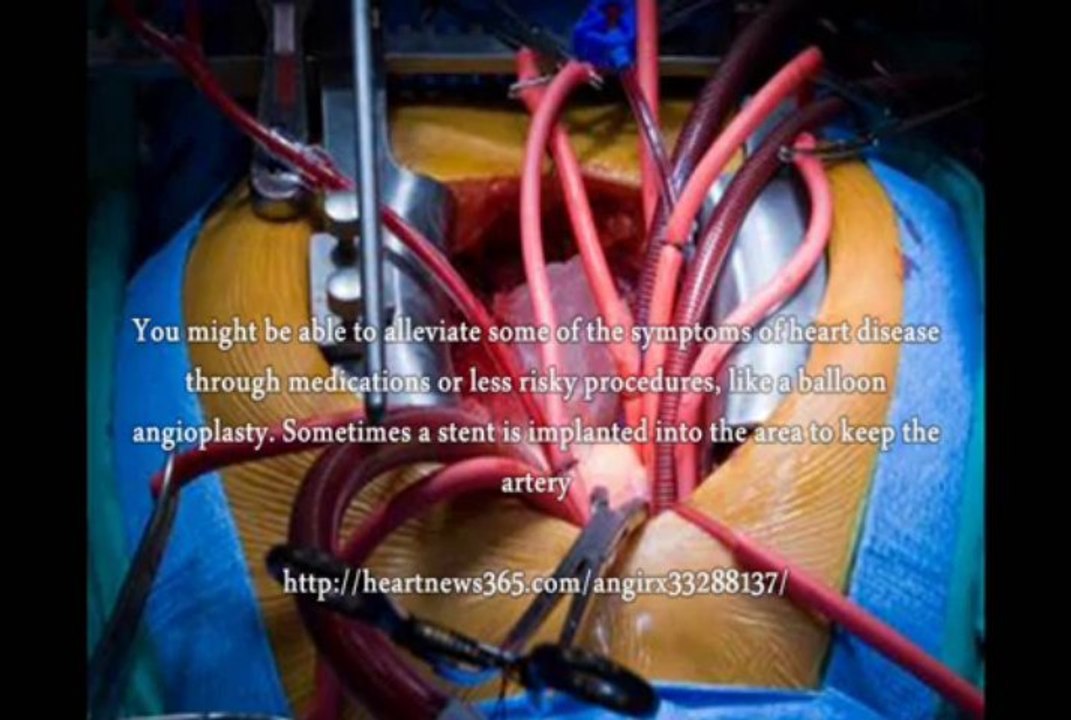 Bypass Surgery Alternative, What Is The Best Bypass Surgery Alternative