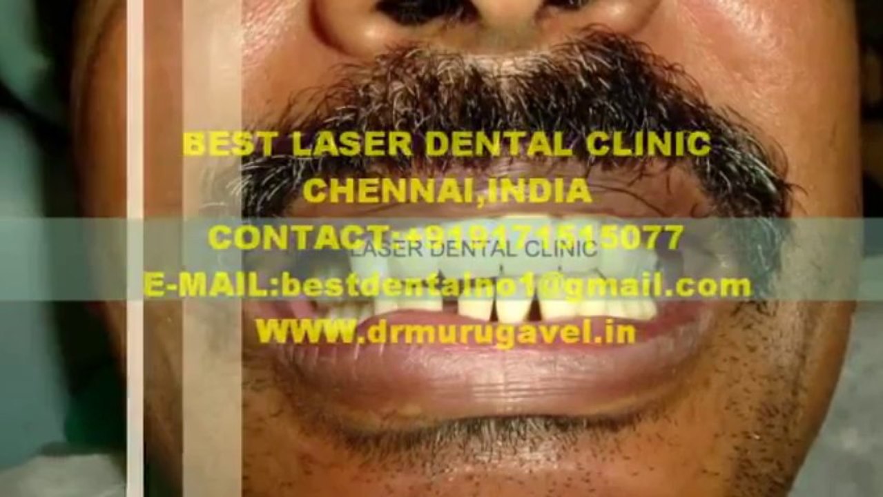 lanap (laser gum treatment)and dental implants for a patient with chronic periodontal tooth abcess-india