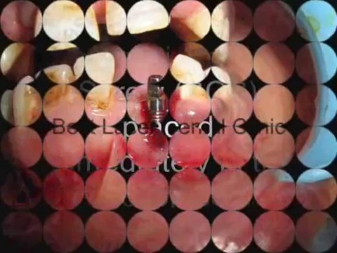 Single tooth extraction and immediate replacement by dental implant-india