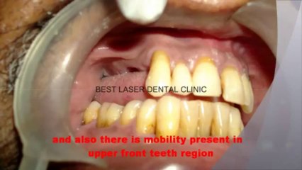 replacing the missing affected teeth - dental implant,chennai, india