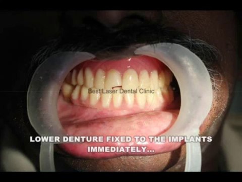 WATCH the simple way to fix your loose lower denture - ALL ON 4 DENTAL IMPLANTS in chennai,india