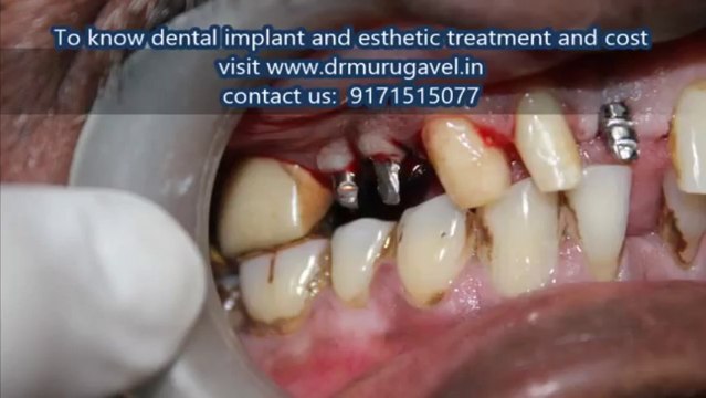 Affordable dental implants in india