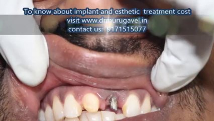 Dental implant centre in India