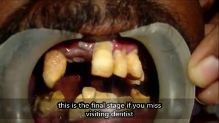 Extreme case of neglected mouth and teeth!!!