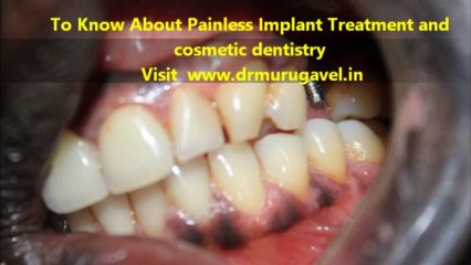 Keyhole dental implant procedure in India