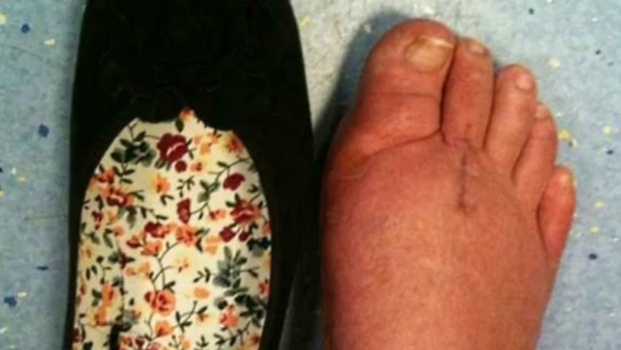 Hallux Valgus Surgery in India | Bunion Surgery in India | Delhi Foot Ankle Clinic