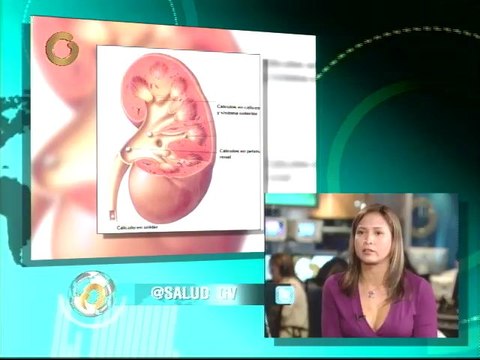 Uróloga: Los cálculos se pueden prevenir con cambios en el estilo de vida