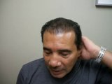 Bosley Hair Transplant Patient Experiences - Adalberto C.