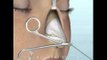 Burun Estetiği Ameliyatı Video İzle- Açık Rinoplasti Videosu, Op Dr H Nazmi Bayçın