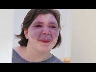 Breakthrough leads to discovery finding cause of port wine birthmarks