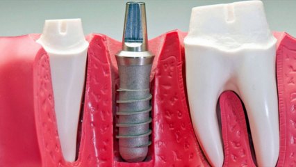 Teeth Whitening And Cosmetic Dentistry Milwaukee & Shorewood, WI - Frank R. Galka, D.D.S