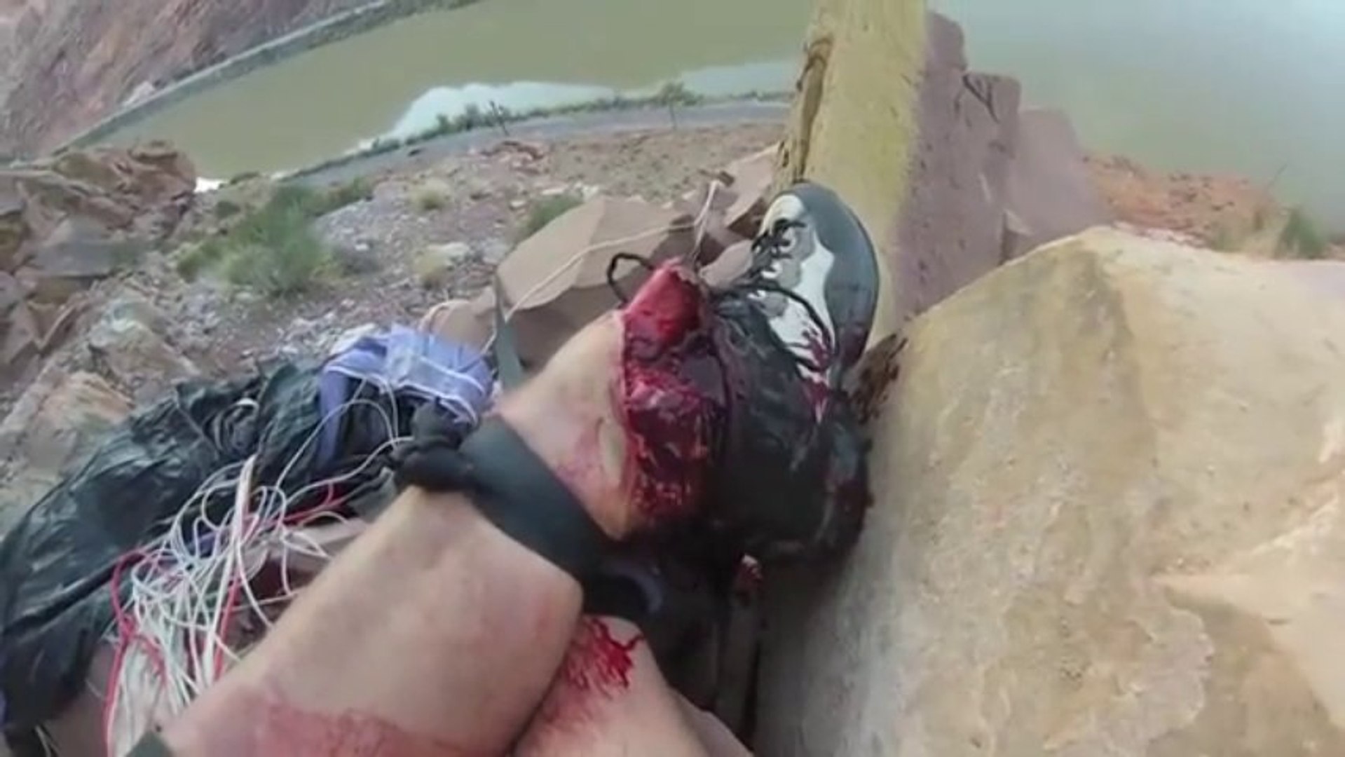 Open Leg Fracture after a Base jump accident. - Vidéo Dailymotion