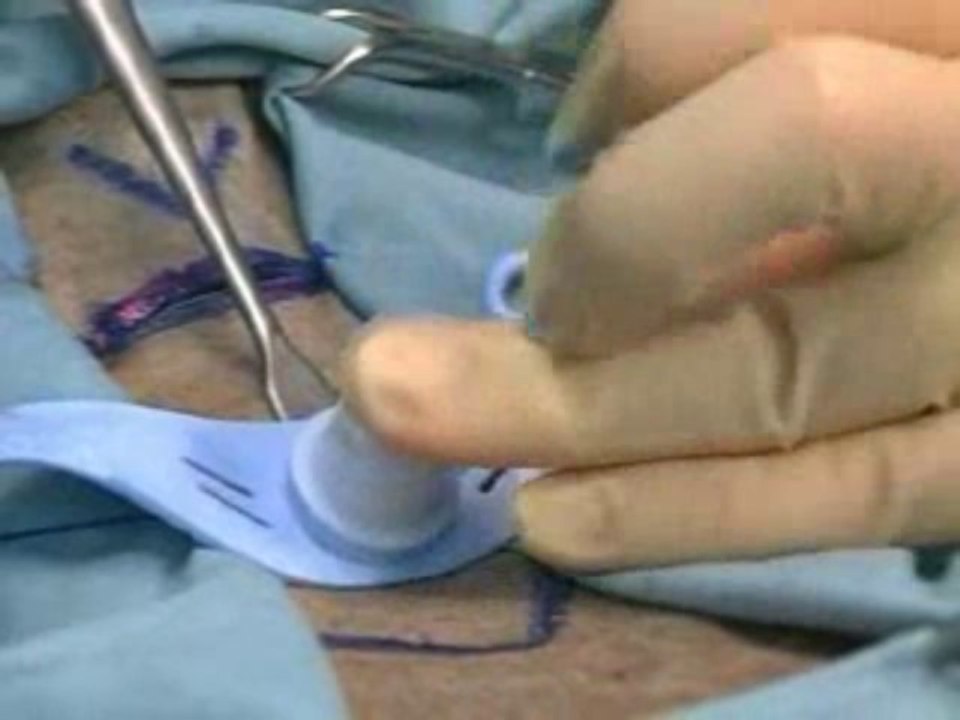 AirwayManagmentSurgical