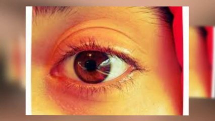 How To Read Eye Prescription