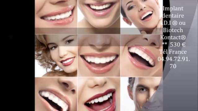 prix implant dentaire espagne Barcelone