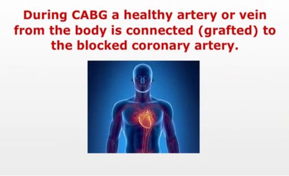 Top Coronary Artery Bypass Graft Surgery Abroad