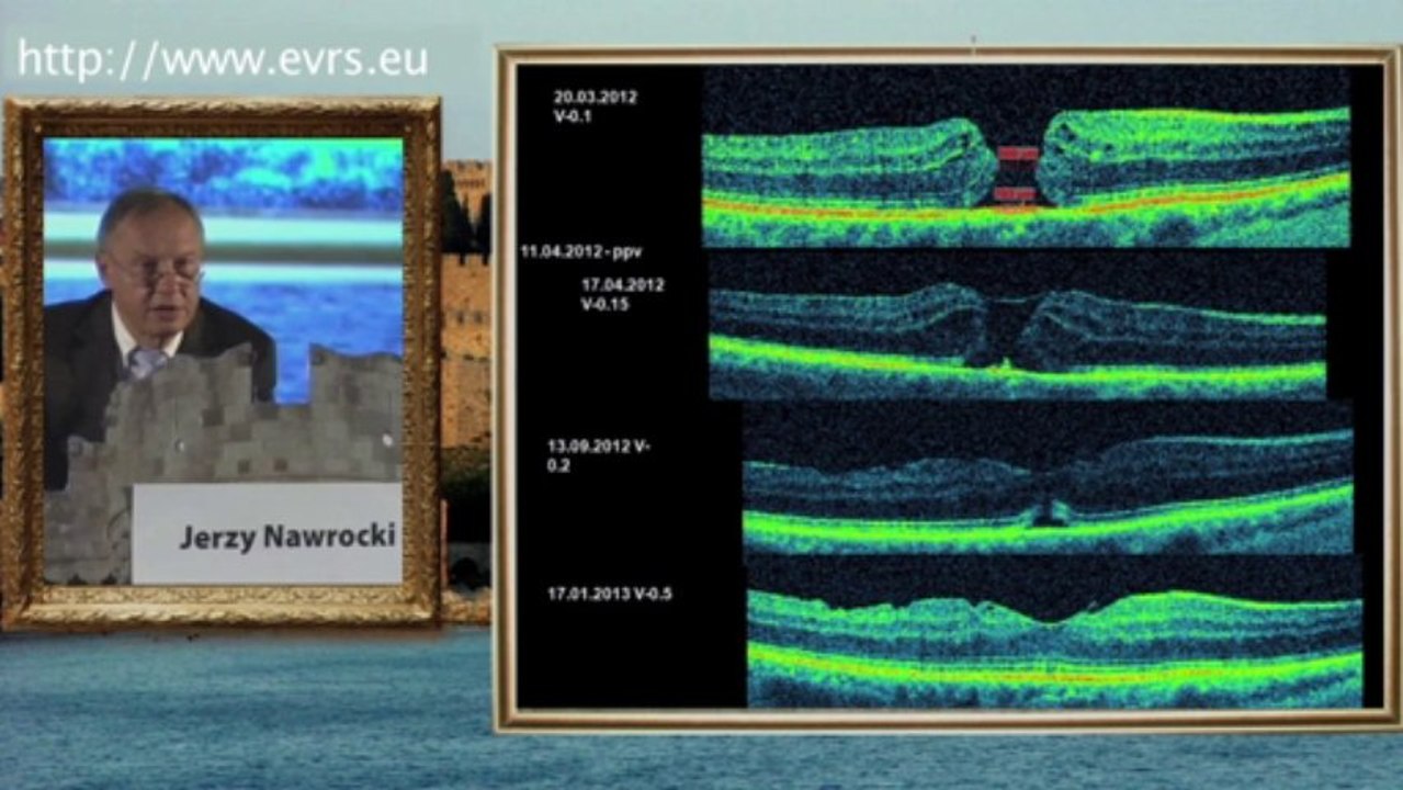 Idiopathic Macular Hole ILM Techniques 2