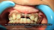 Flapless Dental Implants in chennai