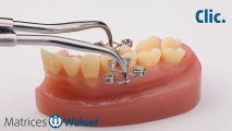 Walser® Matrices Sectionnelles: Utilisation forme X de matrice pour dent