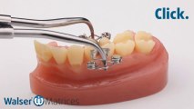 Walser® Sectional Matrix: Application X-form dental matrix