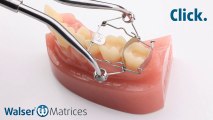 Walser® Sectional Matrices: Application ON-form dental matrix