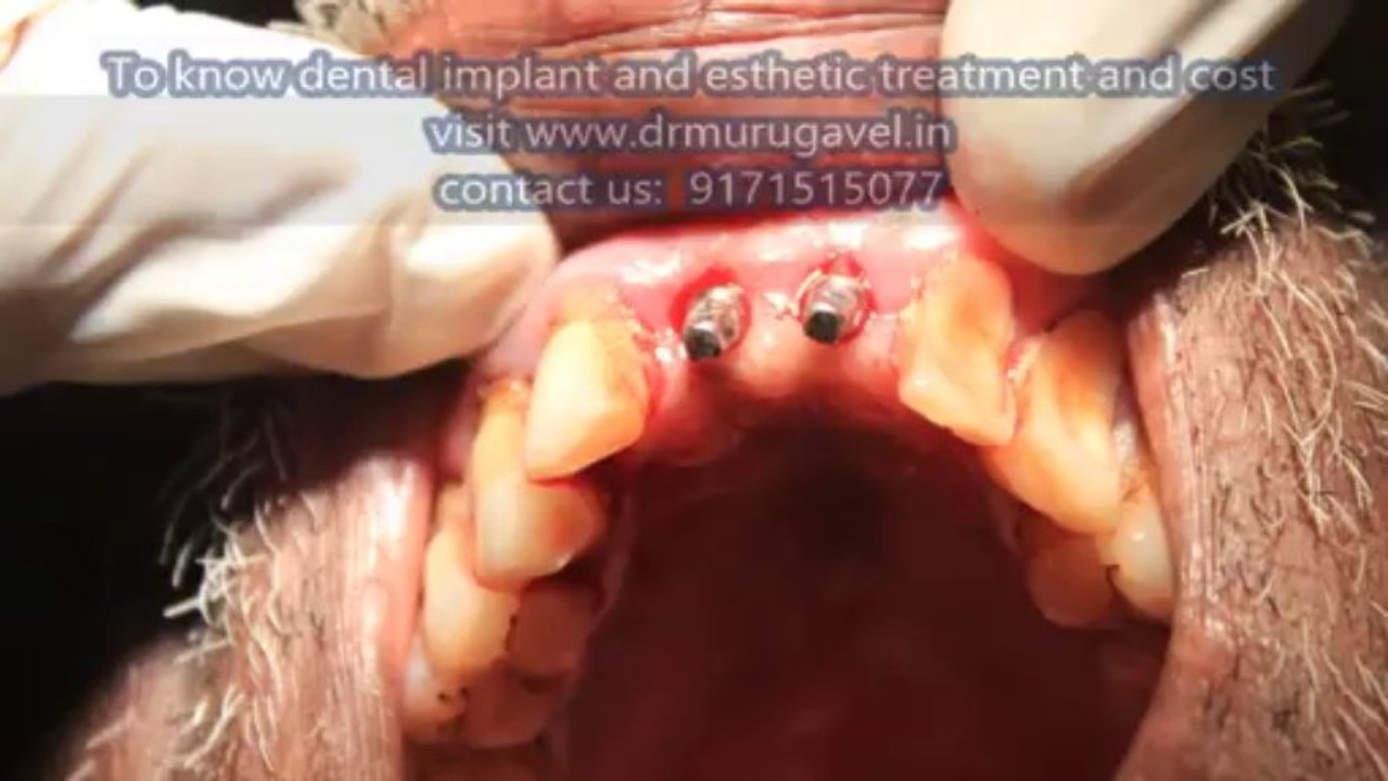 teeth replacement by Single Piece Dental implants in CHENNAI