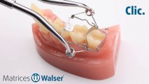 Walser® Matrices Sectionnelles: Utilisation forme ON de matrice pour dent
