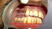 Replacing the missing teeth with Dental Implants in chennai