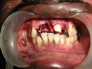 new teeth with advanced dental implants in three days